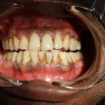 Gusi Hitam Penyebab, Dampak Dan Cara Mengatasinya