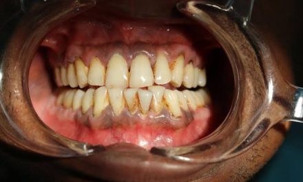 Gusi Hitam Penyebab, Dampak Dan Cara Mengatasinya