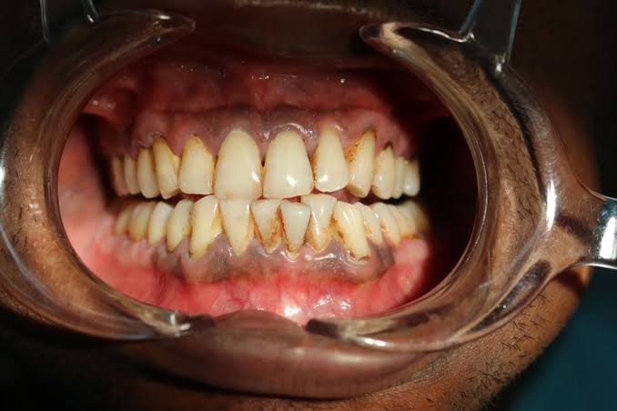 Gusi Hitam Penyebab, Dampak Dan Cara Mengatasinya