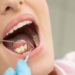 Tips Menghindari Gigi Karang Dengan Kebiasaan Sederhana