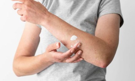 Referensi Obat Panu Yang Ampuh Untuk Anda Coba
