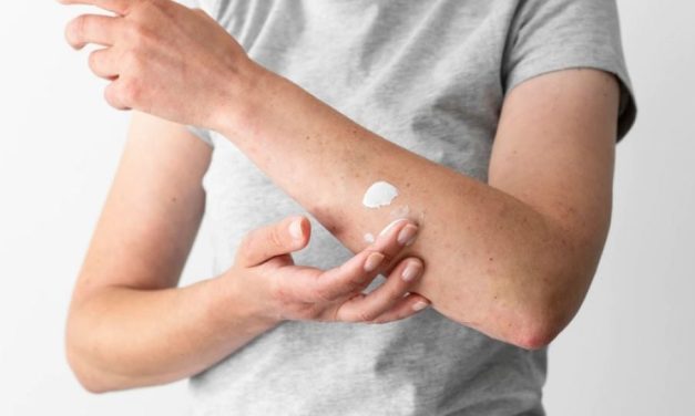 Referensi Obat Panu Yang Ampuh Untuk Anda Coba